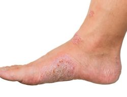 Waspadai Luka di Kaki, Tanda-Tanda Luka Diabetes yang Harus Diwaspadai